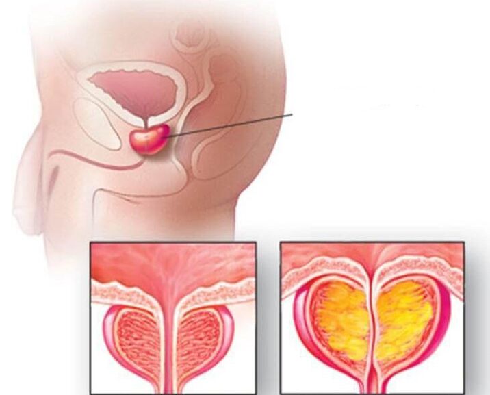 Prostate location, normal and enlarged prostate in chronic prostatitis