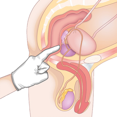 Determine prostate condition by palpation to diagnose prostatitis