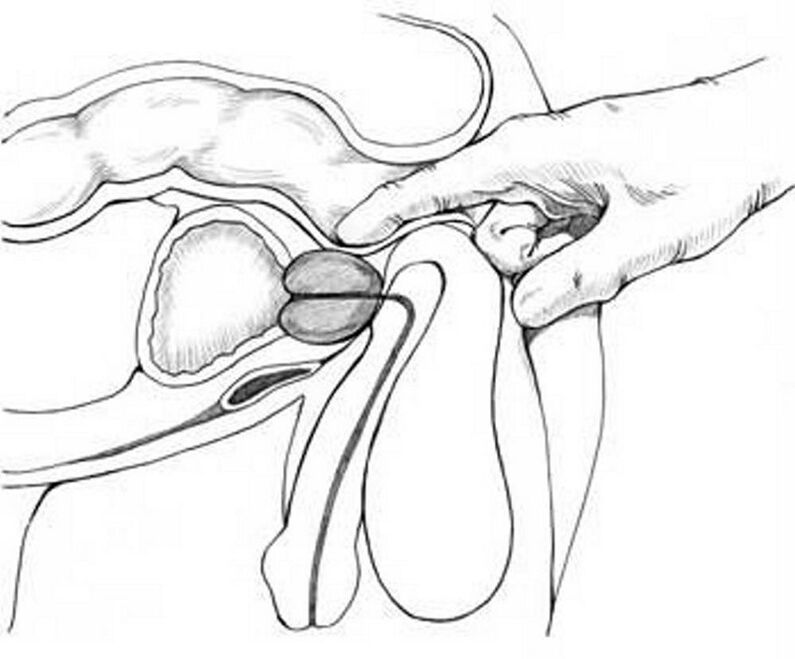 Prostate massage treats chronic prostatitis