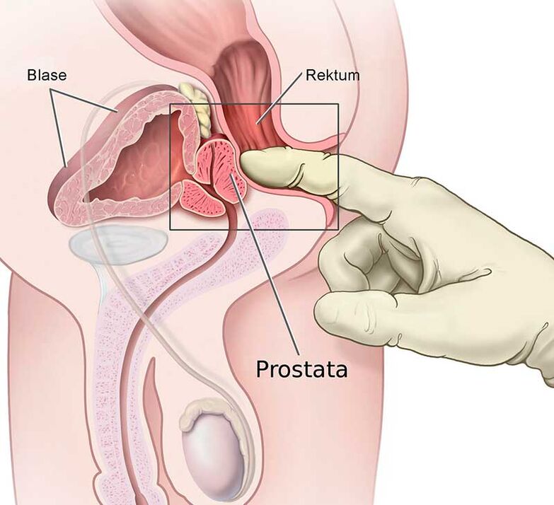Prostate massage for prostatitis