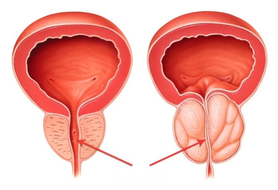 the prostate is healthy and becomes inflamed with prostatitis