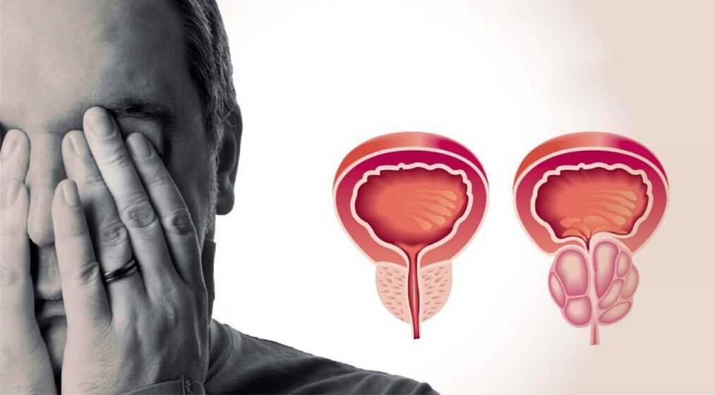 The prostate is healthy and inflamed